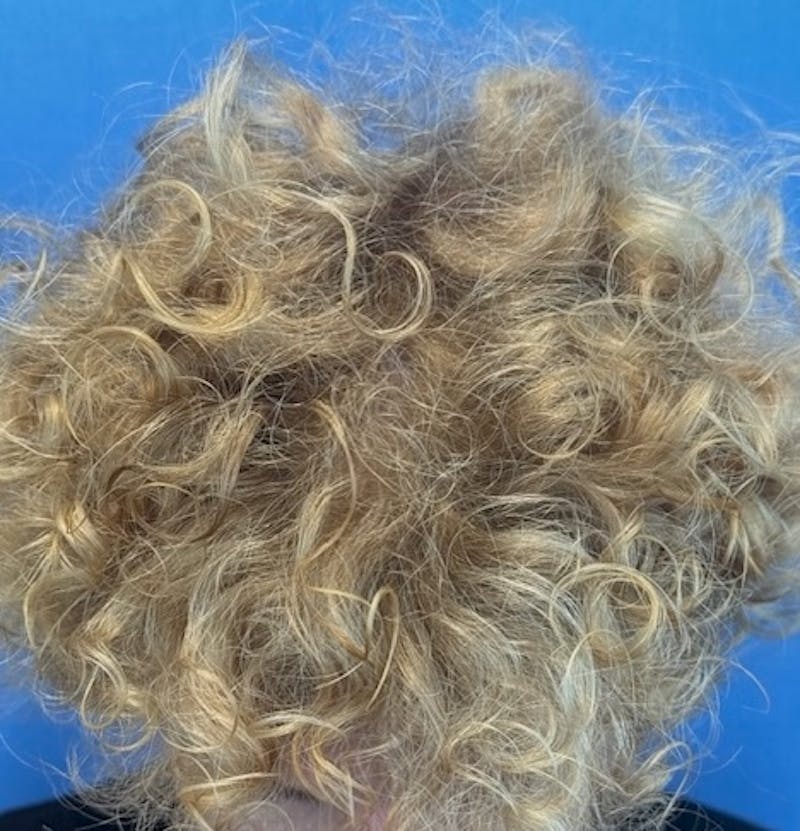 Non-Surgical Before & After Gallery - Patient 423058 - Image 2