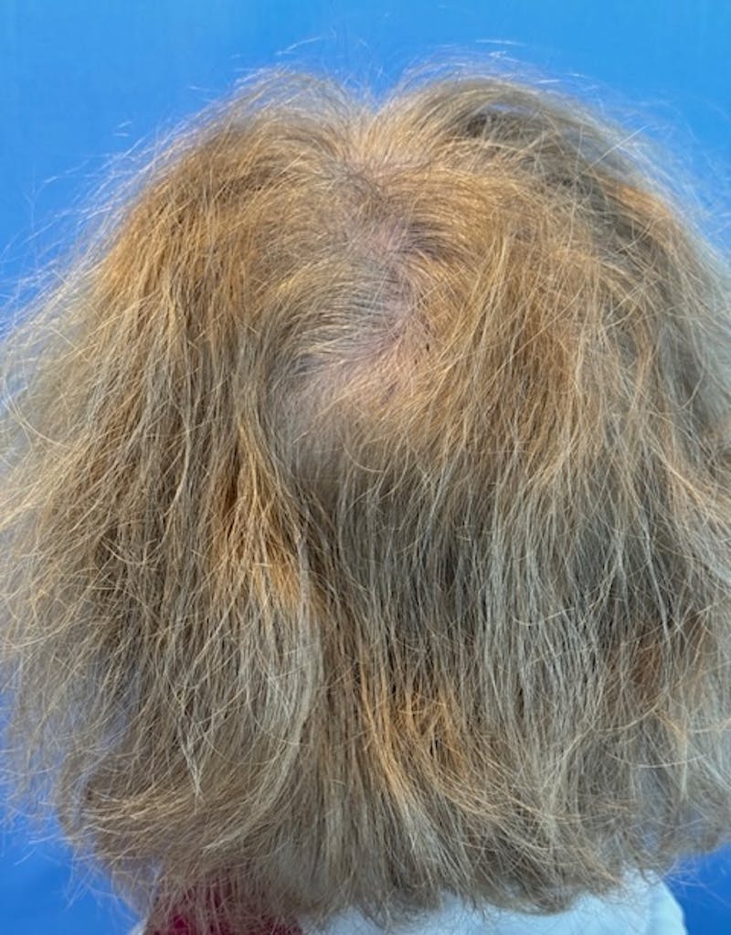 Non-Surgical Before & After Gallery - Patient 423058 - Image 7