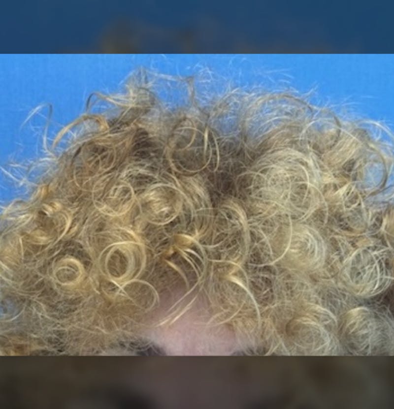 Non-Surgical Before & After Gallery - Patient 423058 - Image 4