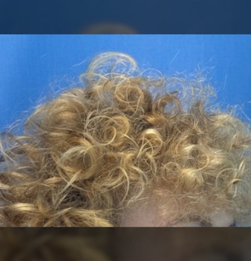 Non-Surgical Before & After Gallery - Patient 423058 - Image 12