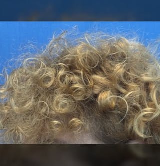 Non-Surgical Before & After Gallery - Patient 423058 - Image 10