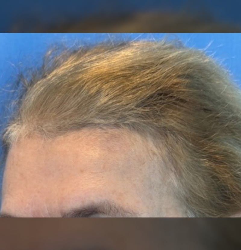 Non-Surgical Before & After Gallery - Patient 423058 - Image 9