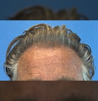 Surgical Before & After Gallery - Patient 307075 - Image 4