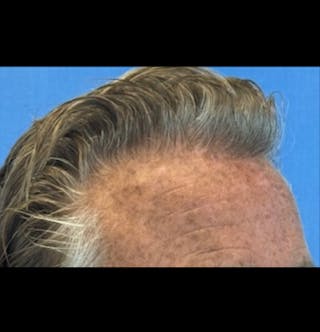 Surgical Before & After Gallery - Patient 307075 - Image 6