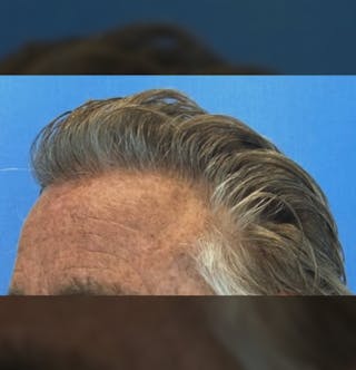 Surgical Before & After Gallery - Patient 307075 - Image 8