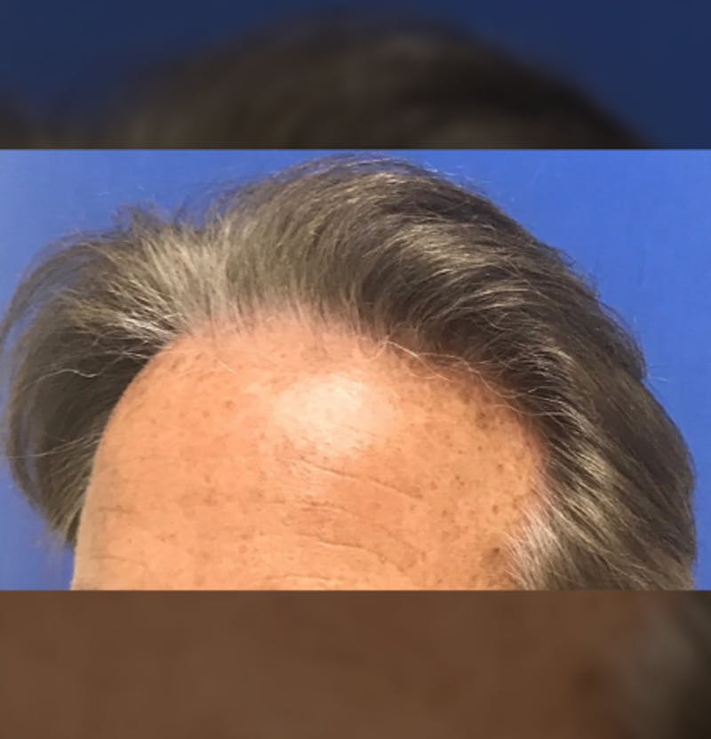 Surgical Before & After Gallery - Patient 307075 - Image 7