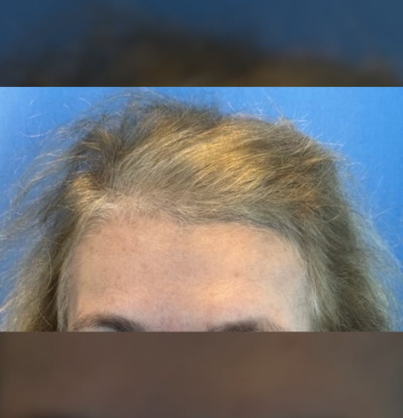 Non-Surgical Before & After Gallery - Patient 423058 - Image 3