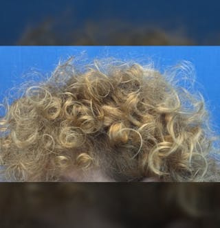Non-Surgical Before & After Gallery - Patient 423058 - Image 10