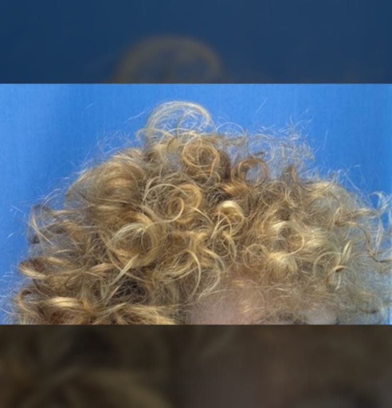 Non-Surgical Before & After Gallery - Patient 423058 - Image 12