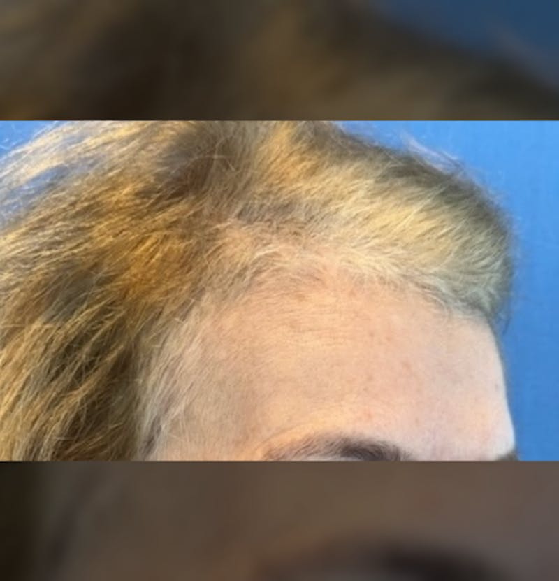 Non-Surgical Before & After Gallery - Patient 423058 - Image 11