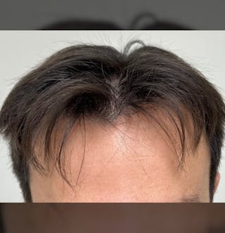 Non-Surgical Before & After Gallery - Patient 662175 - Image 6
