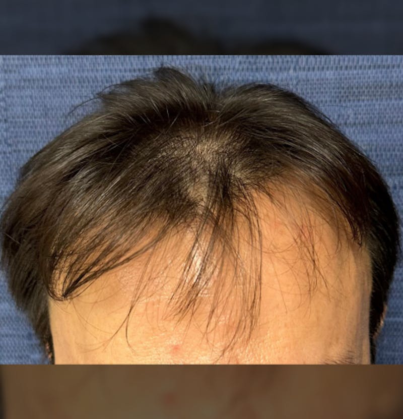 Non-Surgical Before & After Gallery - Patient 662175 - Image 5
