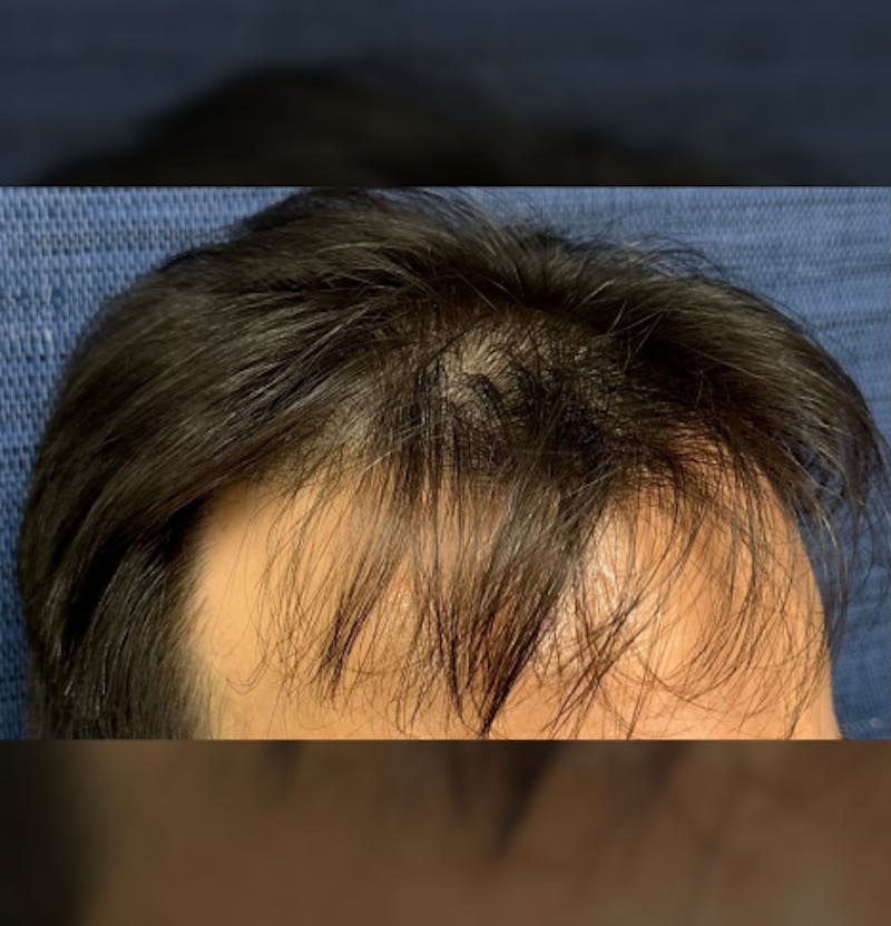 Non-Surgical Before & After Gallery - Patient 662175 - Image 7