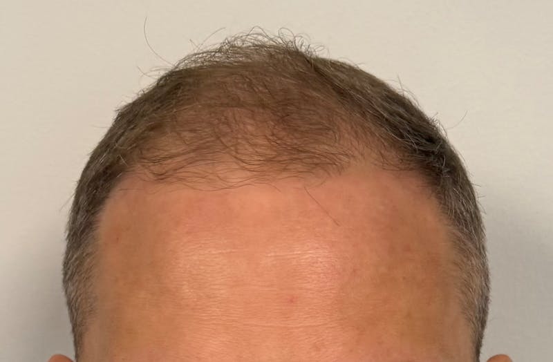 Surgical Before & After Gallery - Patient 558384 - Image 1