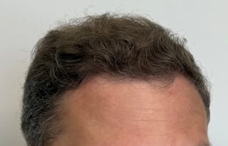 Surgical Before & After Gallery - Patient 558384 - Image 4