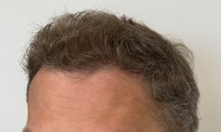 Surgical Before & After Gallery - Patient 558384 - Image 6