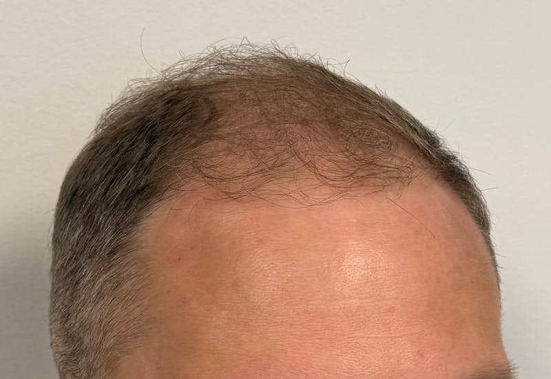 Surgical Before & After Gallery - Patient 558384 - Image 3