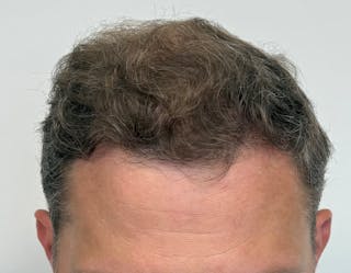 Surgical Before & After Gallery - Patient 558384 - Image 8
