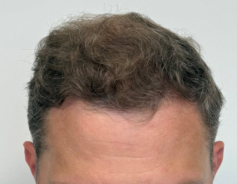 Surgical Before & After Gallery - Patient 558384 - Image 8