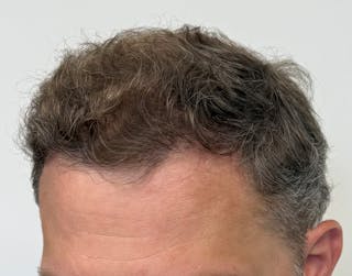 Surgical Before & After Gallery - Patient 558384 - Image 10