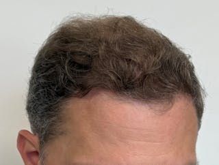 Surgical Before & After Gallery - Patient 558384 - Image 12