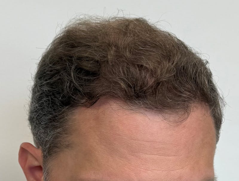 Surgical Before & After Gallery - Patient 558384 - Image 12