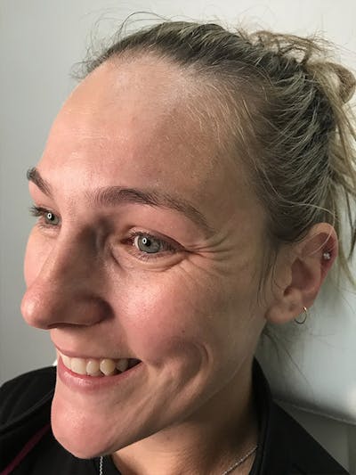 BOTOX Before & After Gallery - Patient 35148683 - Image 1