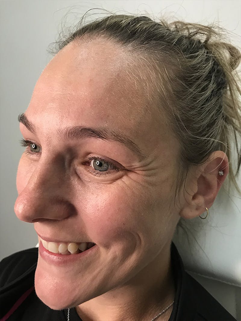 BOTOX Before & After Gallery - Patient 35148683 - Image 1