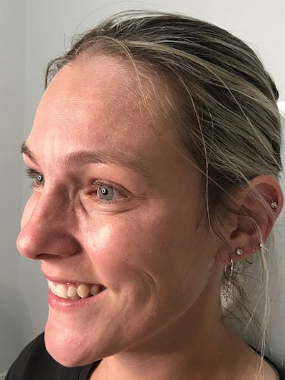 BOTOX Before & After Gallery - Patient 35148683 - Image 2