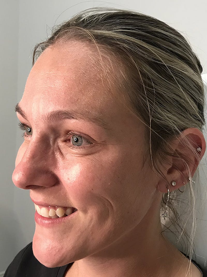 BOTOX Before & After Gallery - Patient 35148683 - Image 2