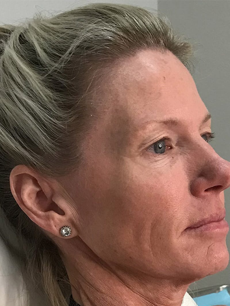 Brow Lift Before & After Gallery - Patient 35148687 - Image 1