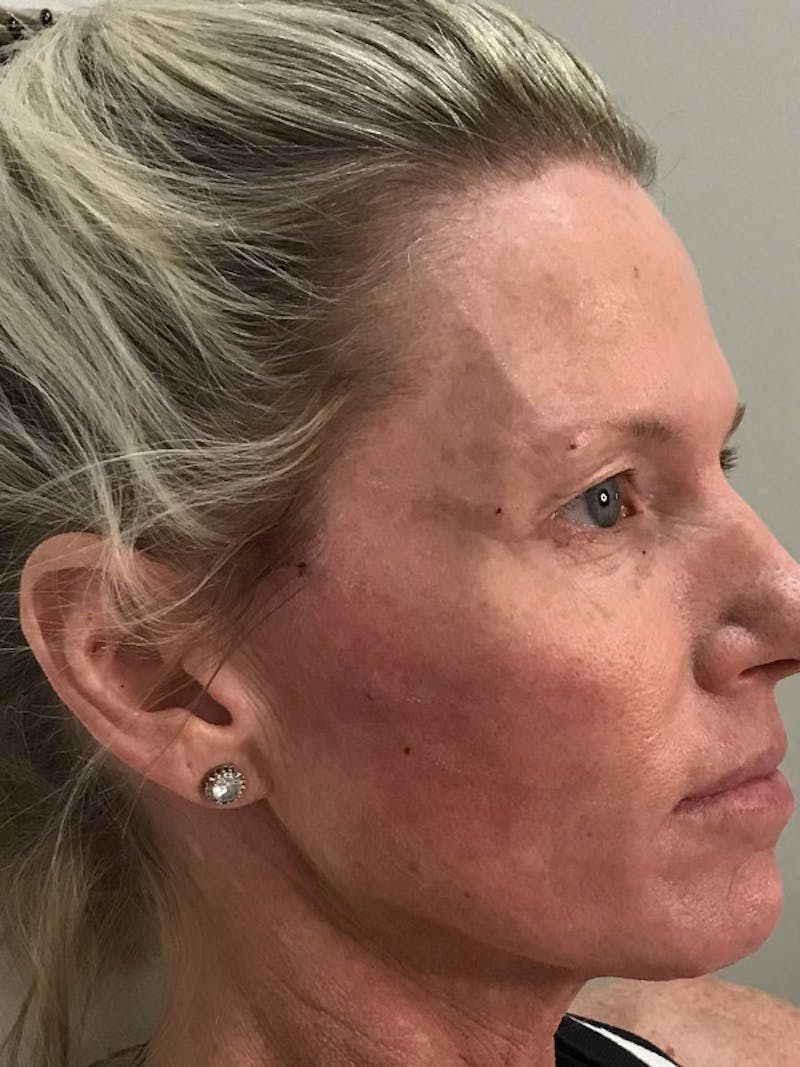 Brow Lift Before & After Gallery - Patient 35148687 - Image 2