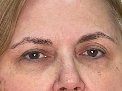 Brow Lift Before & After Gallery - Patient 35148688 - Image 1