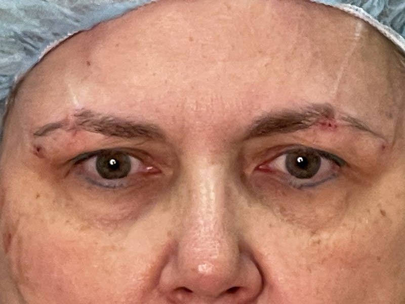 Brow Lift Before & After Gallery - Patient 35148688 - Image 2