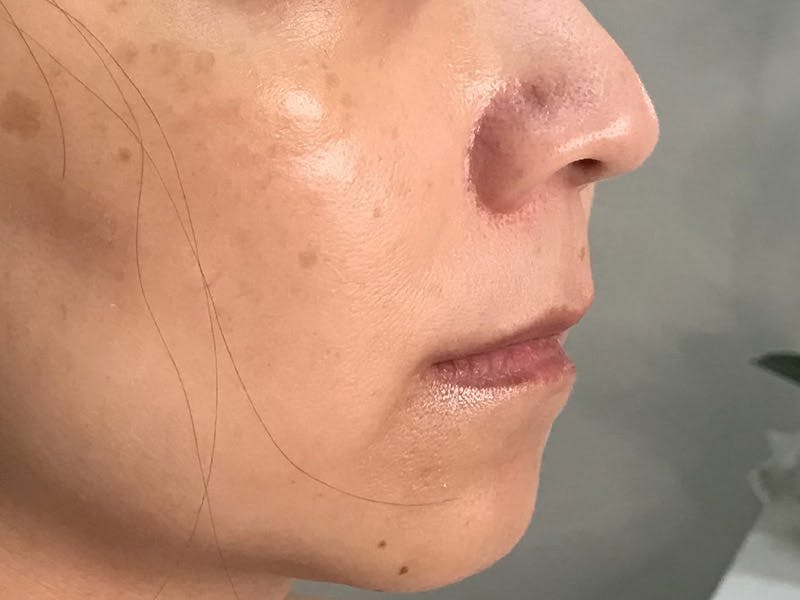 Lip Filler Before & After Gallery - Patient 35148691 - Image 1
