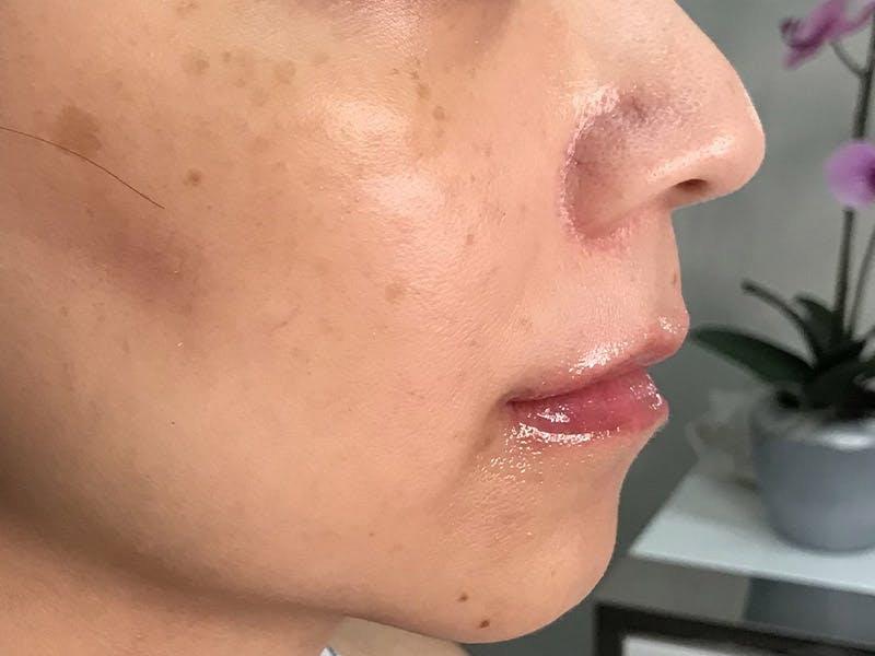 Lip Filler Before & After Gallery - Patient 35148691 - Image 2