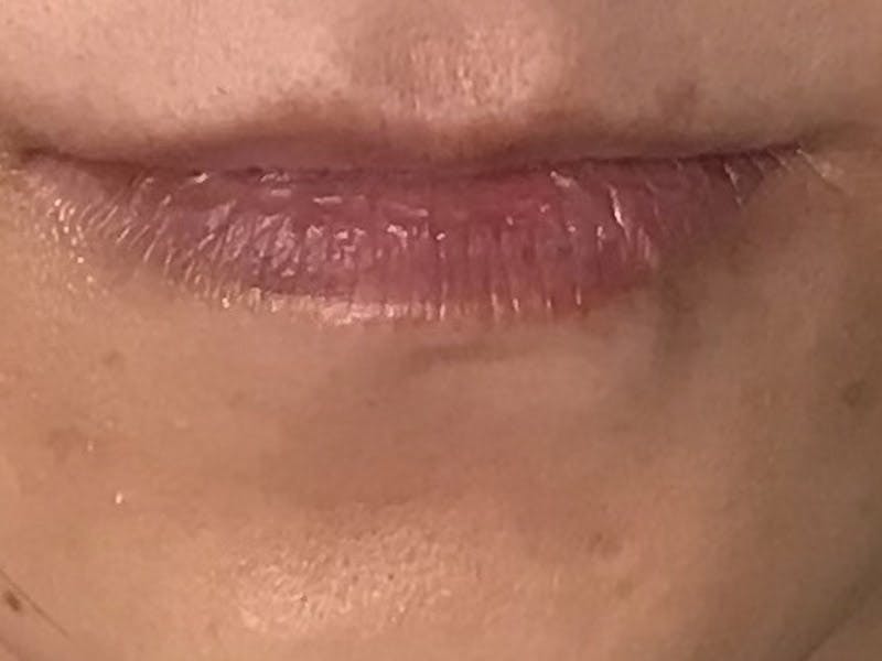 Lip Filler Before & After Gallery - Patient 35148691 - Image 3