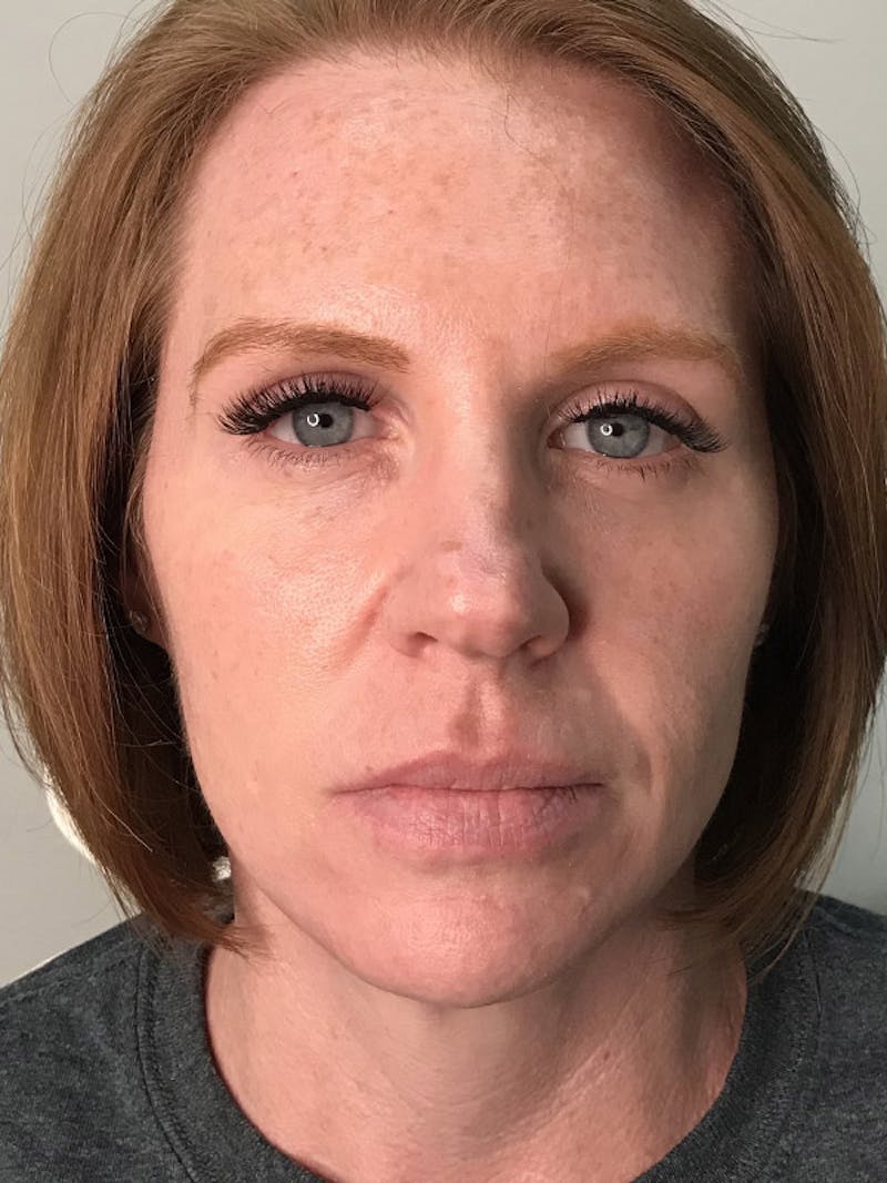 Lip Filler Before & After Gallery - Patient 35148692 - Image 1