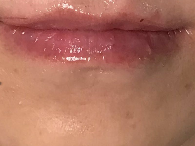 Lip Filler Before & After Gallery - Patient 35148691 - Image 4