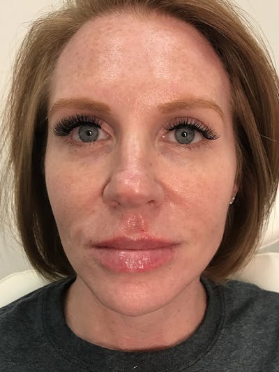 Lip Filler Before & After Gallery - Patient 35148692 - Image 2