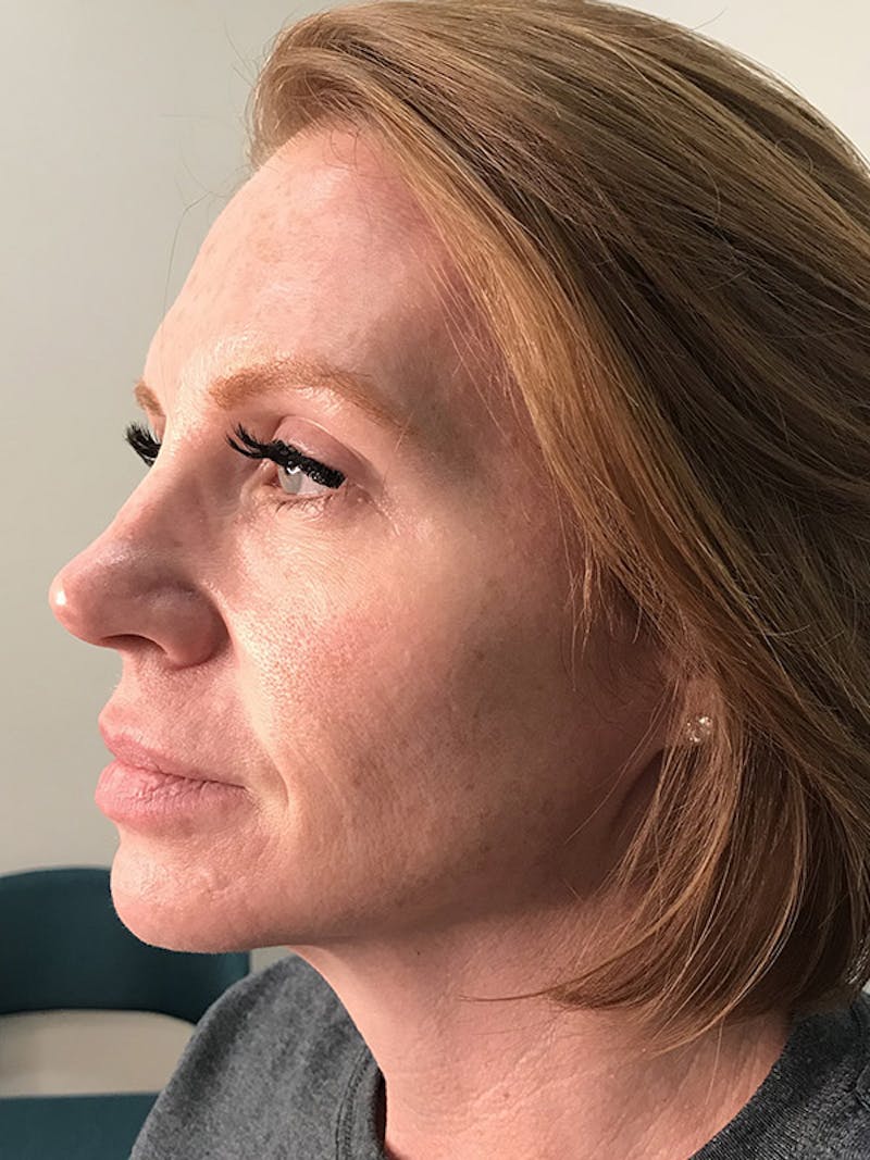 Lip Filler Before & After Gallery - Patient 35148692 - Image 3