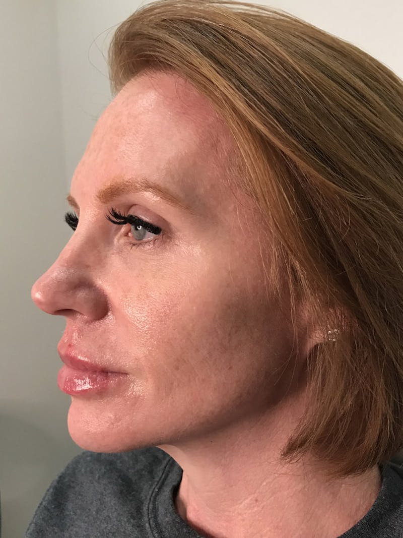 Lip Filler Before & After Gallery - Patient 35148692 - Image 4