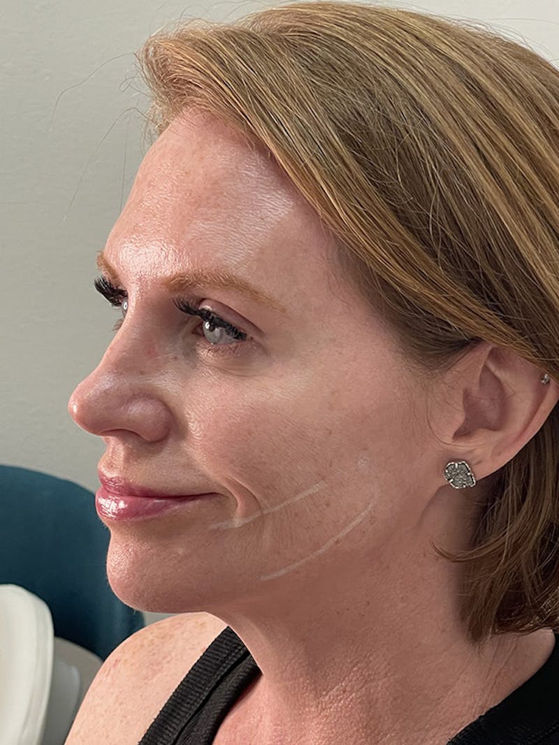 Lip Filler Before & After Gallery - Patient 35148692 - Image 5