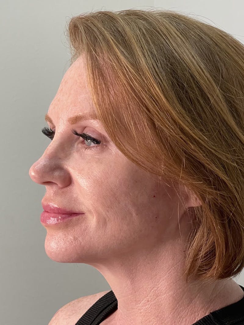 Lip Filler Before & After Gallery - Patient 35148692 - Image 6