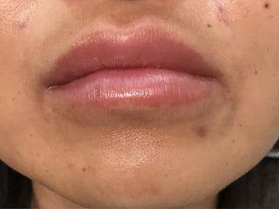 Lip Filler Before & After Gallery - Patient 35148693 - Image 1
