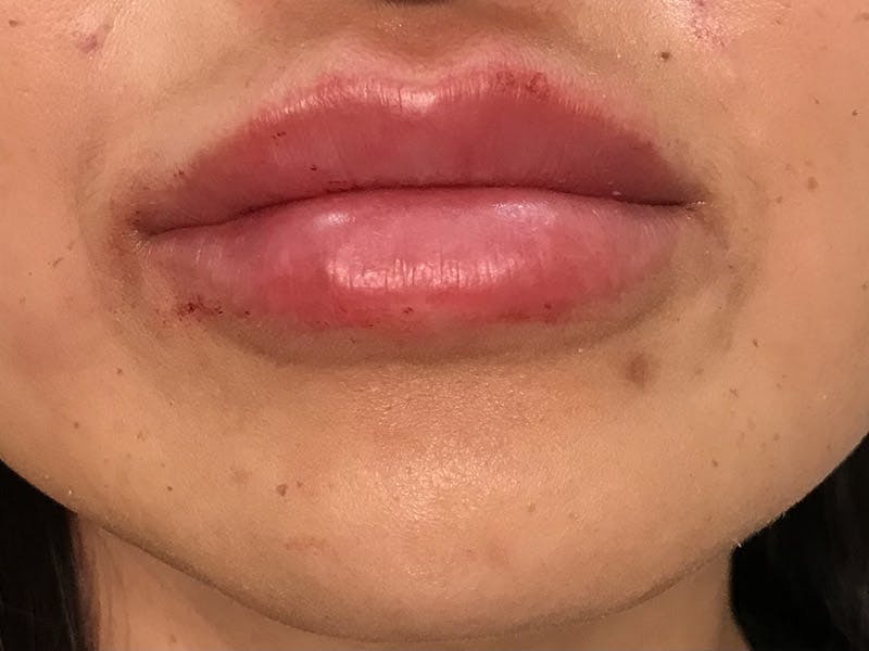 Lip Filler Before & After Gallery - Patient 35148693 - Image 2