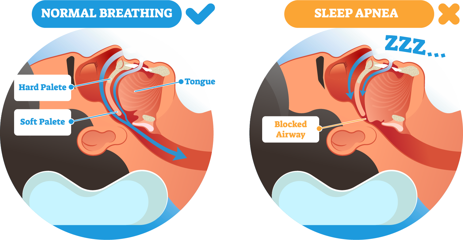 Obstructive Sleep Apnea Roller Weight Loss