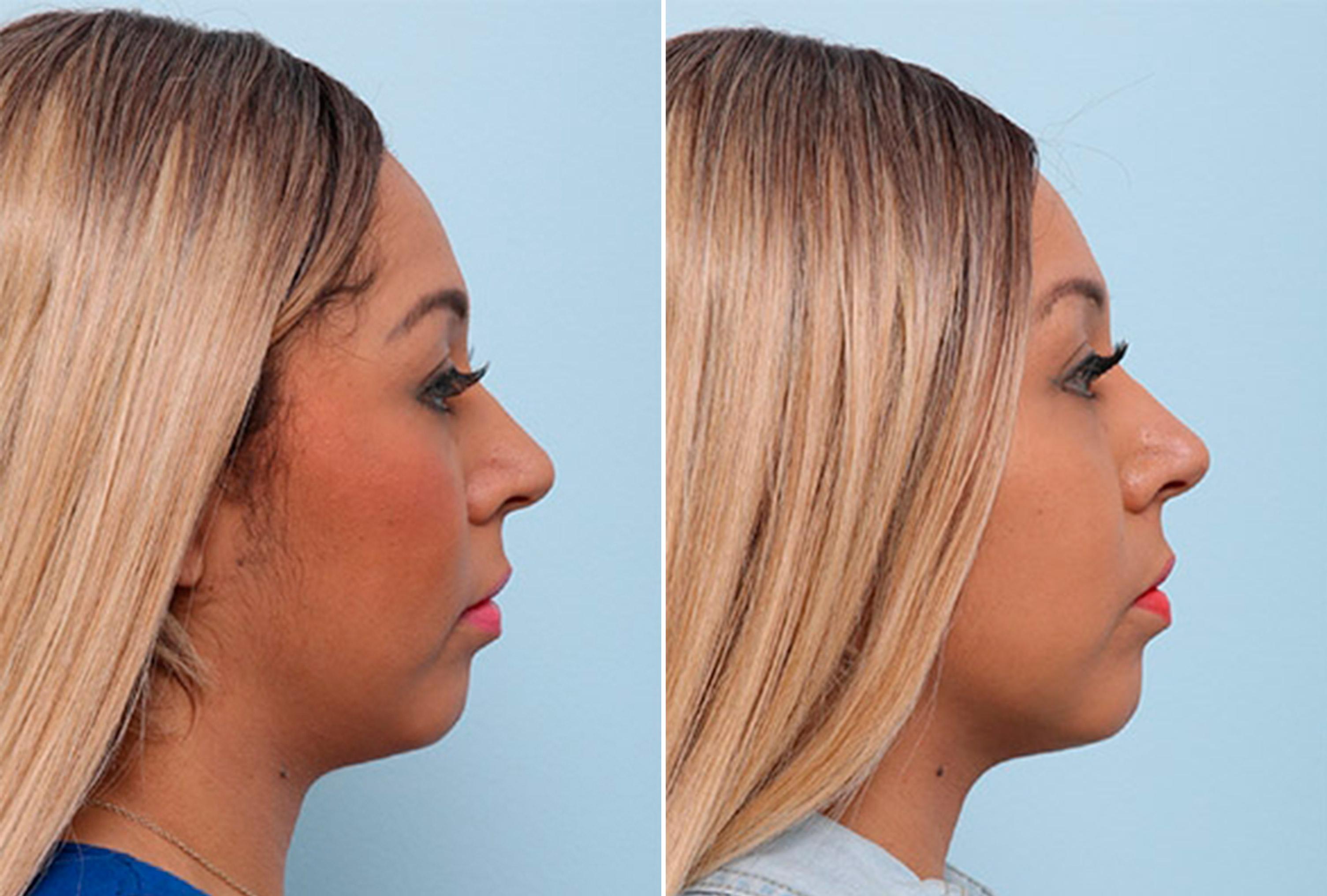 Buccal Fat Pad Removal Before and After Photos in Houston, TX, Patient 27775