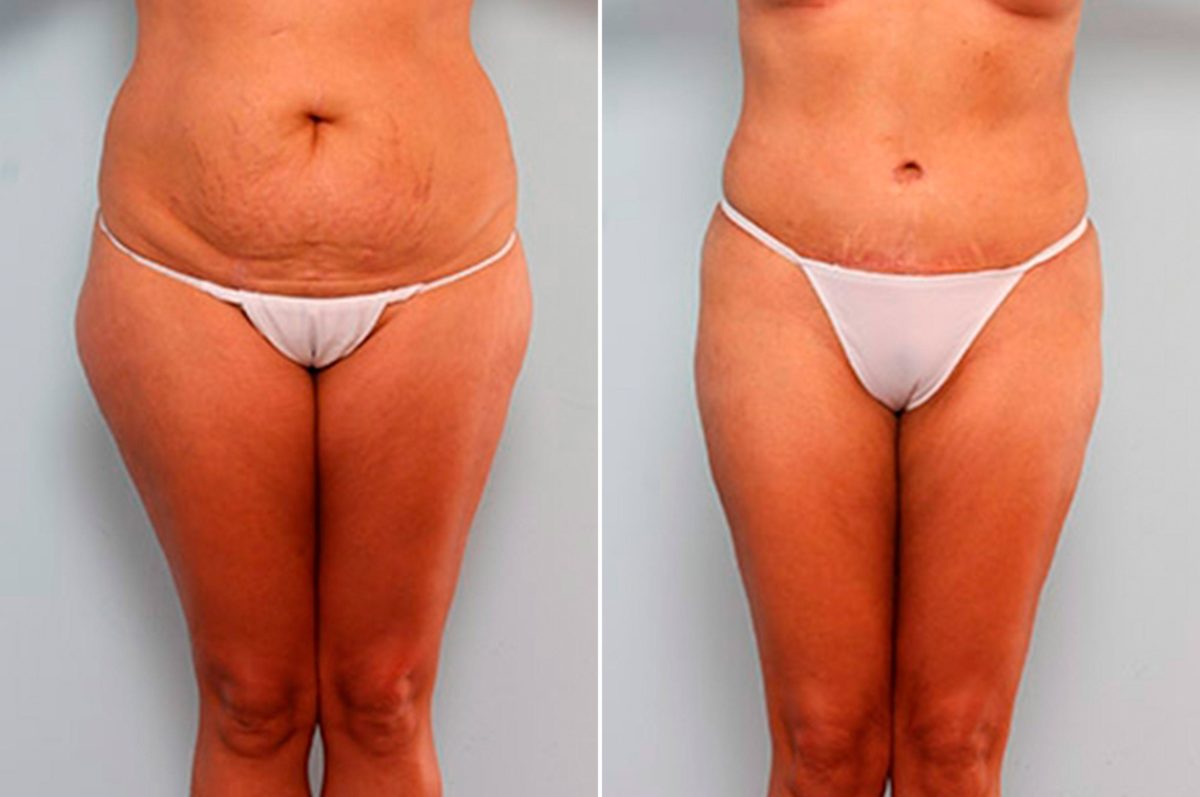 What Is a Mommy Makeover?, Before and After Photos Mommy Makeover Before and After Photos in Houston, TX, Patient 29288
