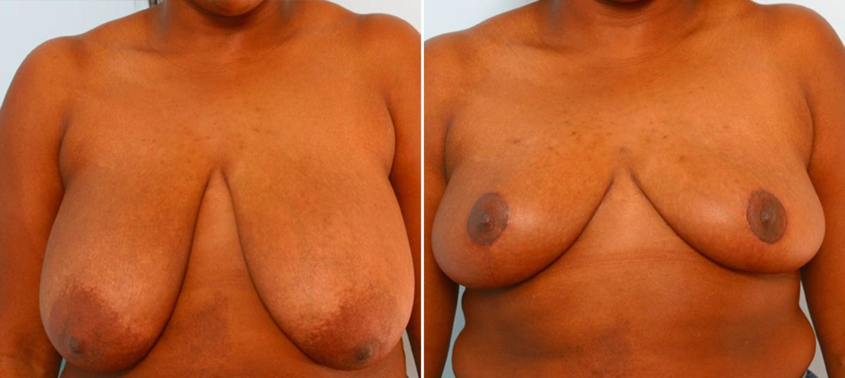 Breast Reduction Before and After Photos in Houston, TX, Patient 27566